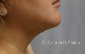  Before and After Cosmetic Surgery in Oakland, CA 