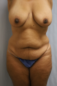  Before and After Cosmetic Surgery in Oakland, CA 